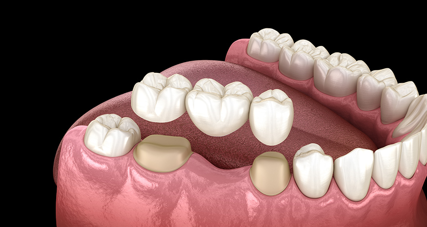 Dental bridge replacing a missing tooth