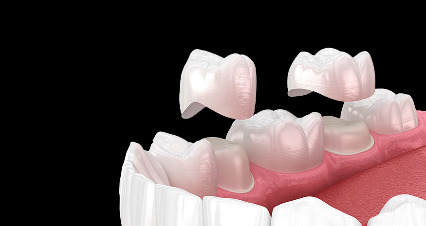 Dental crown used to restore a damaged tooth