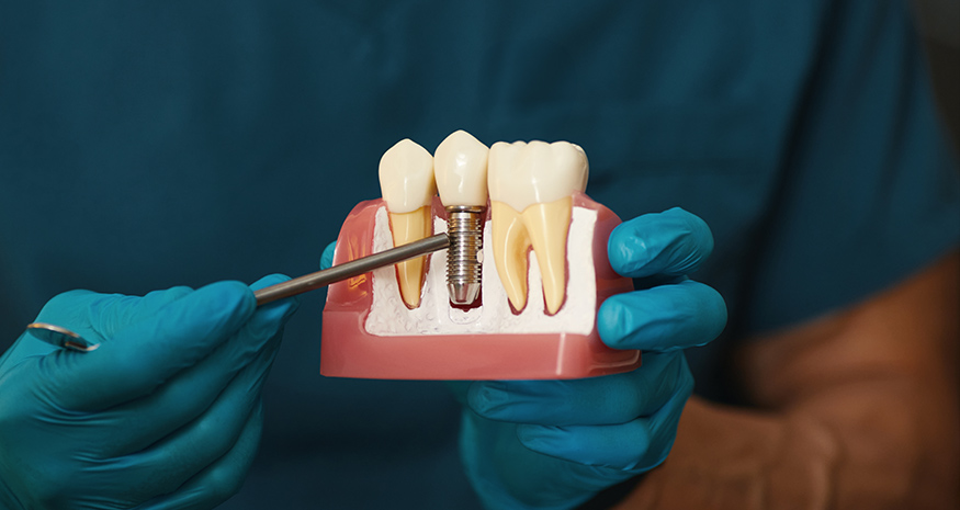 Dental implant used to replace a missing tooth