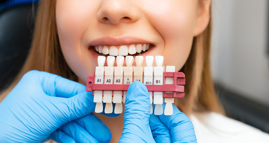 Natural-looking porcelain veneers