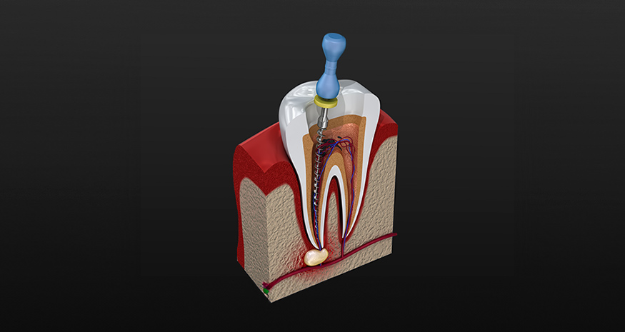 Root canal treatment used to preserve a natural tooth