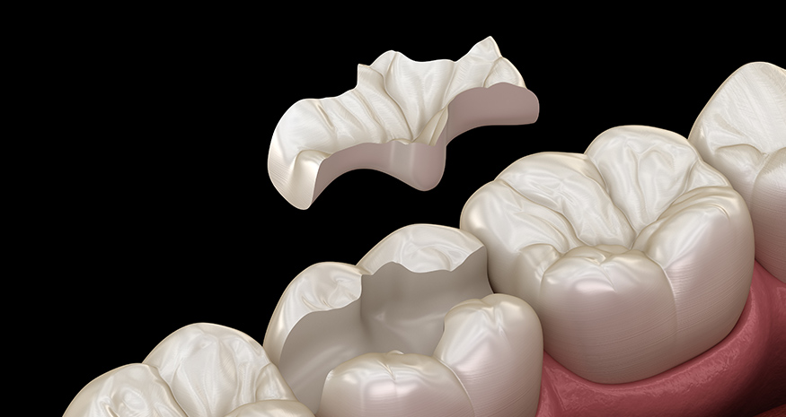 Natural-looking tooth-colored dental filling