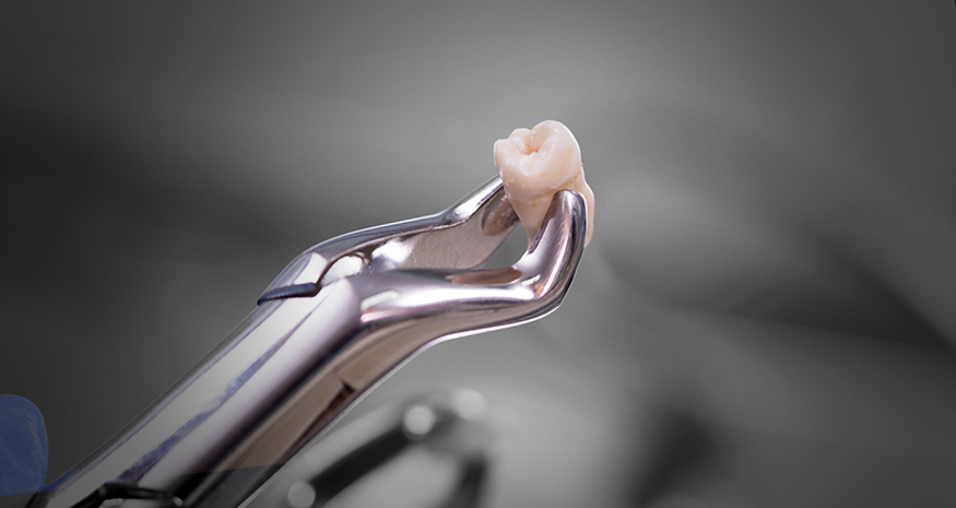 Comfortable tooth extraction care
