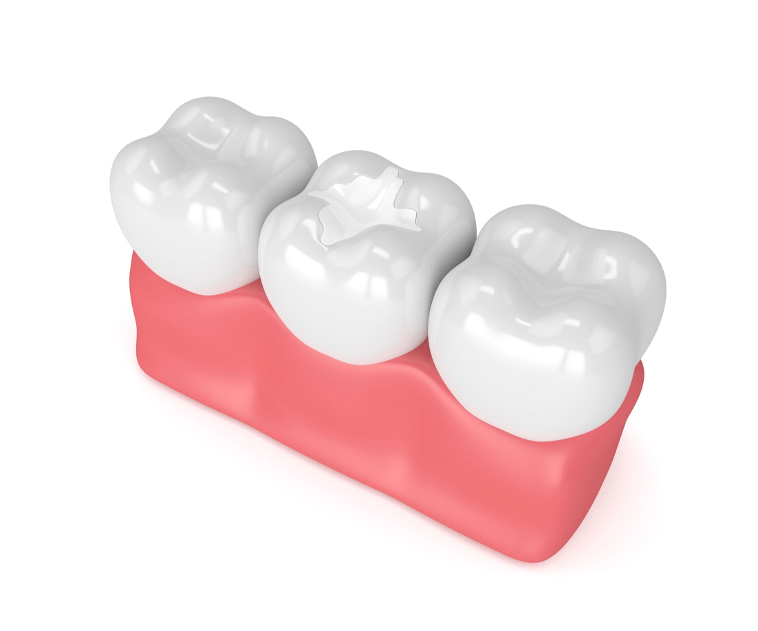 Natural-looking composite tooth-colored filling