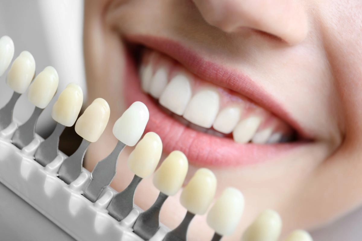 Professional teeth whitening in Manchester, New Hampshire